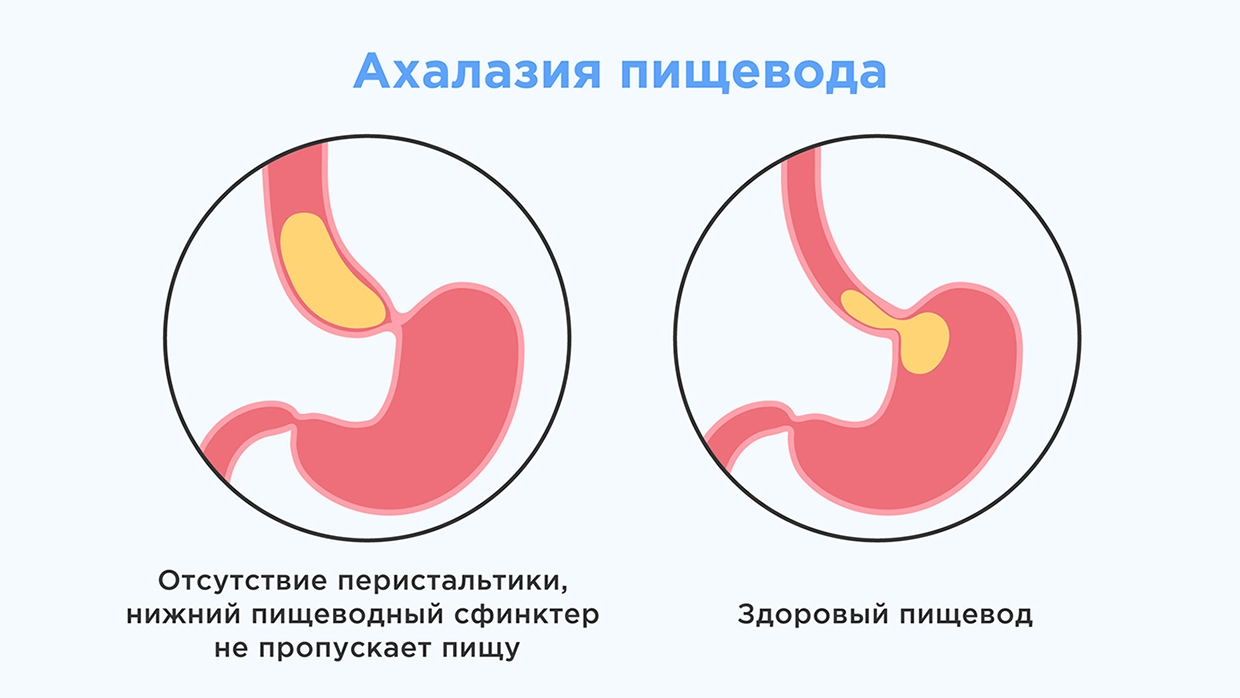 Ахалазия пищевода - симптомы, причины, диагностика и методы лечения